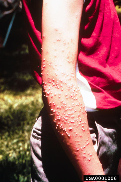 Fire Ant Stings on Arm